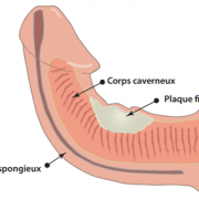 Penis courbé : causes, et traitements en cas verge tordue ou de maladie de Lapeyronie