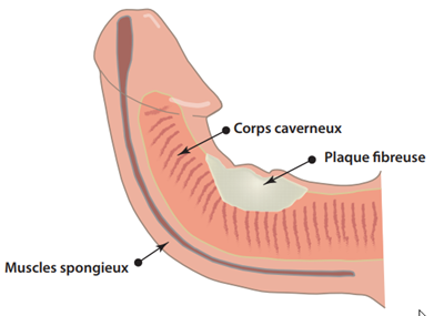 Penis courbé : causes, et traitements en cas verge tordue ou de maladie de Lapeyronie